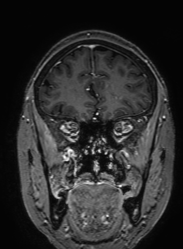 Cavernous hemangioma of the cerebellar falx (Radiopaedia 73025-83724 Coronal T1 C+ 101).jpg