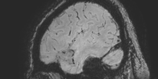 Cavernous hemangioma of the cerebellar falx (Radiopaedia 73025-83724 Sagittal BOLD 174).jpg