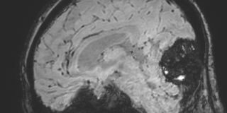 File:Cavernous hemangioma of the cerebellar falx (Radiopaedia 73025-83724 Sagittal BOLD 96).jpg