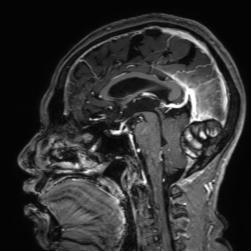 Cavernous hemangioma of the cerebellar falx (Radiopaedia 73025-83724 Sagittal T1 C+ 106).jpg