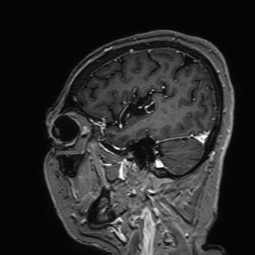 Cavernous hemangioma of the cerebellar falx (Radiopaedia 73025-83724 Sagittal T1 C+ 46).jpg