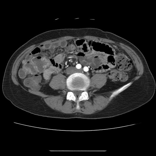 Cavernous hepatic hemangioma (Radiopaedia 75441-86667 A 70).jpg