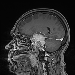 Cavernous sinus meningioma (Radiopaedia 63682-72367 Sagittal T1 C+ 75).jpg