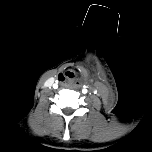 File:Cavernous sinus thrombosis (Radiopaedia 10619-11078 A 22).jpg