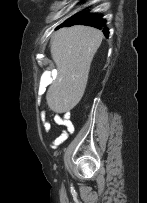 Cecal adenocarcinoma - surgical scar recurrence (Radiopaedia 79988-93264 D 52).jpg