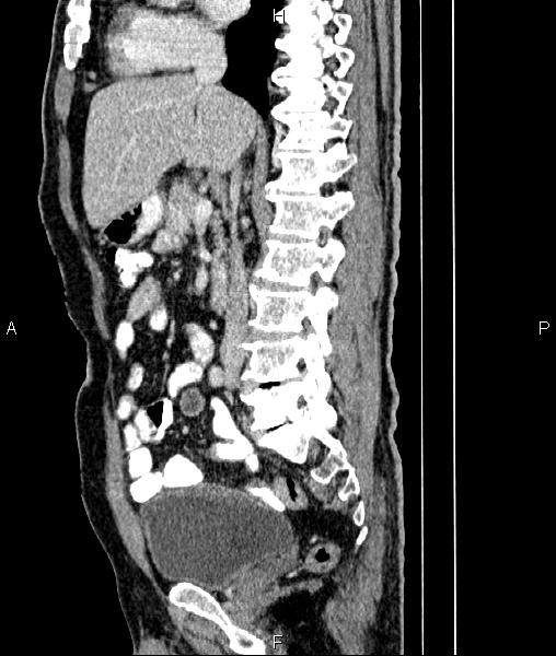 File:Cecal cancer with appendiceal mucocele (Radiopaedia 91080-108651 E 45).jpg