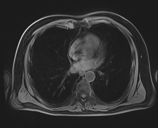 Cecal mass causing appendicitis (Radiopaedia 59207-66532 Axial T1 6).jpg
