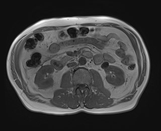Cecal mass causing appendicitis (Radiopaedia 59207-66532 Axial T1 in-phase 66).jpg