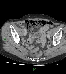 Cecal volvulus (Radiopaedia 86741-102900 A 111).jpg