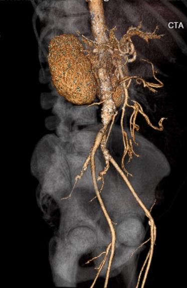 File:Celiac artery severe stenosis and dissection (Radiopaedia 44128-47842 C+ arterial phase 6).jpg
