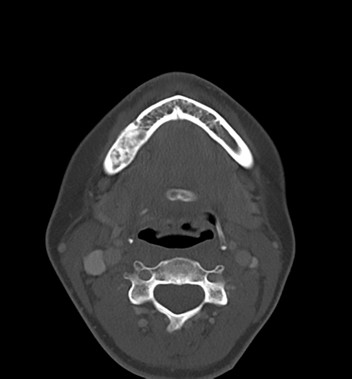 Cemento-ossifying fibroma (Radiopaedia 46243-50643 Axial bone window 46).png