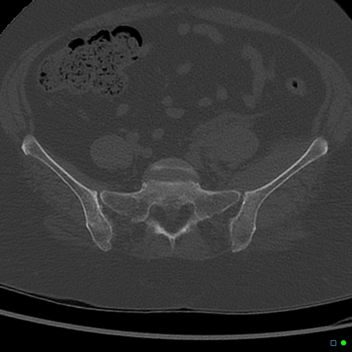 File:Central fracture-dislocation of the acetabulum (Radiopaedia 36578-38150 Axial bone window 9).jpg