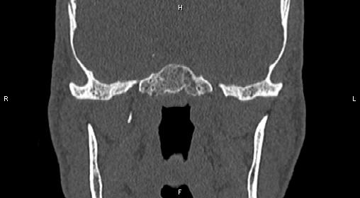 Central giant cell granuloma (Radiopaedia 83346-97761 Coronal bone window 26).jpg