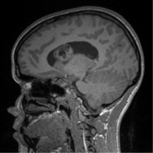 Central neurocytoma (Radiopaedia 37664-39557 Sagittal T1 57).png