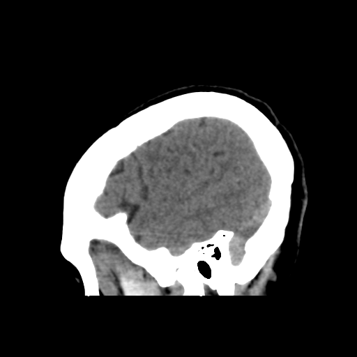 File:Central neurocytoma (Radiopaedia 65317-74346 C 44).png