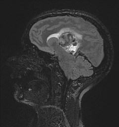 Central neurocytoma (Radiopaedia 84497-99872 Sagittal Flair + Gd 86).jpg