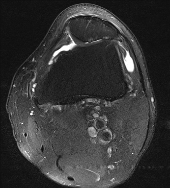 File:Central osteophyte (Radiopaedia 72592-83150 Axial PD fat sat 8).jpg