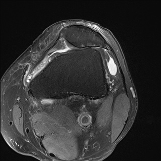 File:Central osteophyte (Radiopaedia 72592-83151 Axial PD fat sat 7).jpg