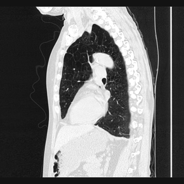Centrilobular pulmonary emphysema (Radiopaedia 24495-24789 Sagittal lung window 50).jpg