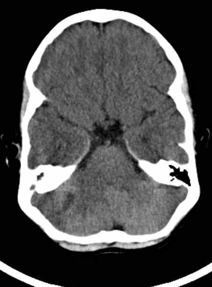 Cerebellar abscess (Radiopaedia 73727-84527 Axial non-contrast 29).jpg