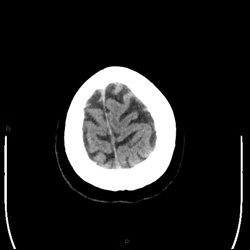 Cerebellar abscess (Radiopaedia 78135-90671 Axial non-contrast 102).jpg