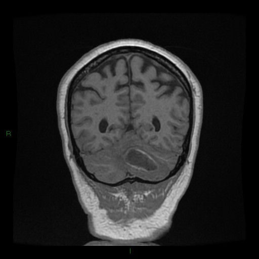 Cerebellar abscess (Radiopaedia 78135-90678 Coronal T1 C+ 128).jpg