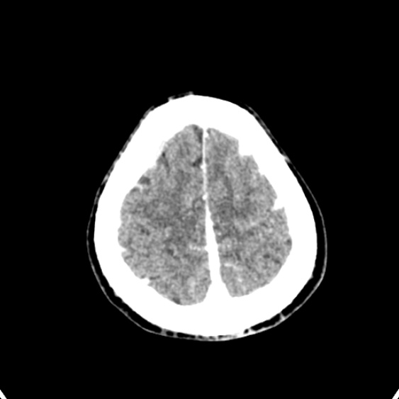 Cerebellar abscess secondary to mastoiditis (Radiopaedia 26284-26412 Axial C+ delayed 137).jpg