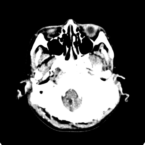 Cerebellar abscess secondary to mastoiditis (Radiopaedia 26284-26412 Axial C+ delayed 16).jpg