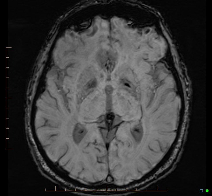 Cerebellar gangliocytoma (Radiopaedia 65377-74422 Axial SWI 28).jpg