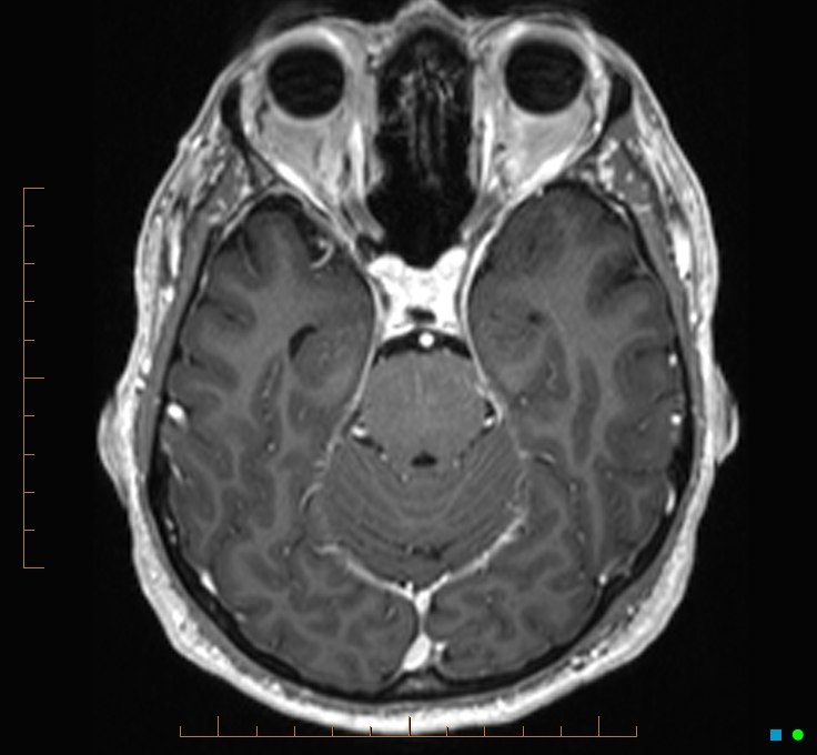 Cerebellar gangliocytoma (Radiopaedia 65377-74422 Axial T1 C+ 41).jpg