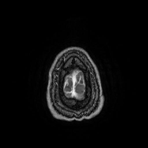 File:Cerebellar hemangioblastoma (Radiopaedia 88055-104622 Axial T1 C+ 164).jpg