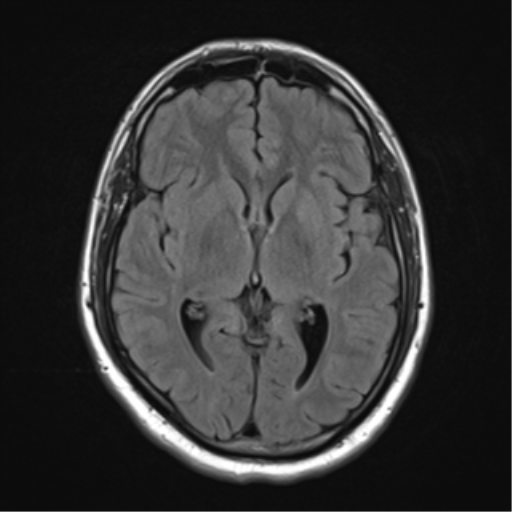 File:Cerebellar hemangioblastomas and pituitary adenoma (Radiopaedia 85490-101176 Axial FLAIR 15).png