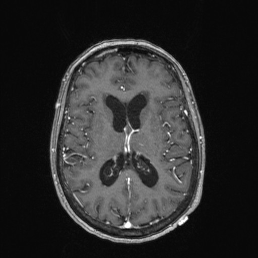 Cerebellar metastases (Radiopaedia 24038-24249 Axial T1 C+ 10).jpg