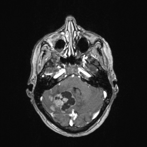 File:Cerebellar metastases (Radiopaedia 24038-24249 Axial T1 C+ 39).jpg