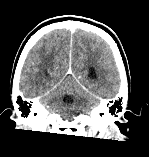 Cerebellar metastases - colorectal adenocarcinoma (Radiopaedia 40947-43652 Coronal C+ 64).png