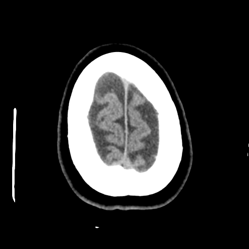 Cerebellar metastasis (cystic appearance) (Radiopaedia 41395-44258 Axial non-contrast 48).png