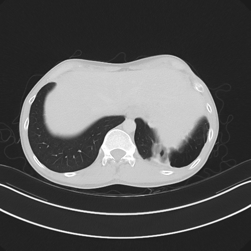 Cerebellar metastasis - adenocarcinoma lung (Radiopaedia 63184-71717 Axial lung window 60).png