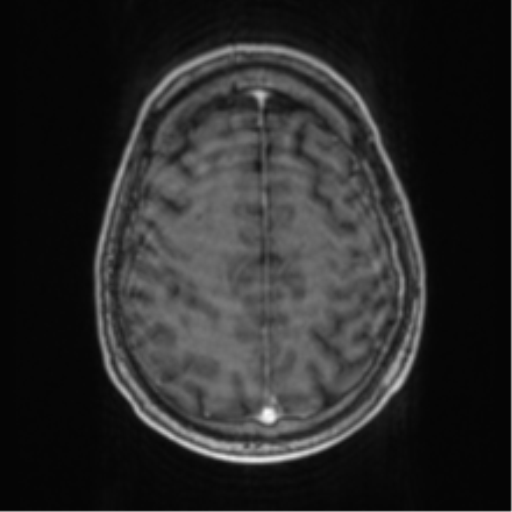 Cerebellar metastasis from lung adenocarcinoma (Radiopaedia 86690-102829 Axial T1 C+ 62).png