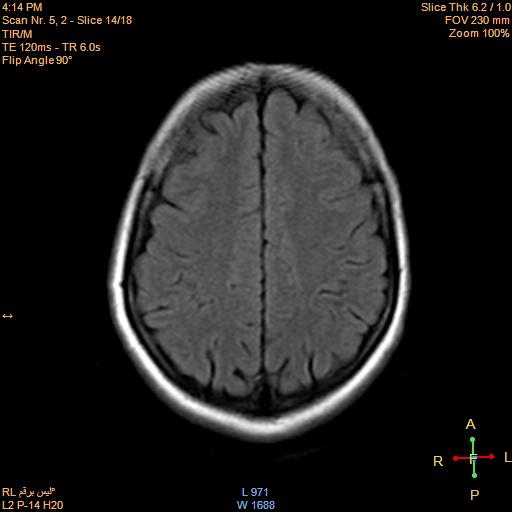 File:Cerebellopontine angle meningioma (Radiopaedia 22488-22525 Axial FLAIR 13).jpg