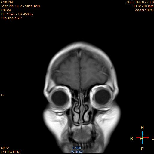 File:Cerebellopontine angle meningioma (Radiopaedia 22488-22525 Coronal T1 C+ 1).jpg