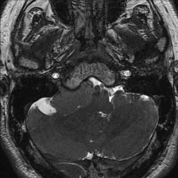 Cerebellopontine angle meningioma (Radiopaedia 24459-24764 I 15).jpg