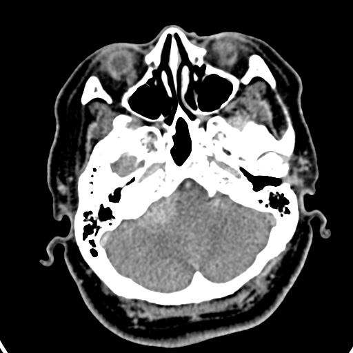 Cerebellopontine angle meningioma (Radiopaedia 35181-36714 A 36).jpg