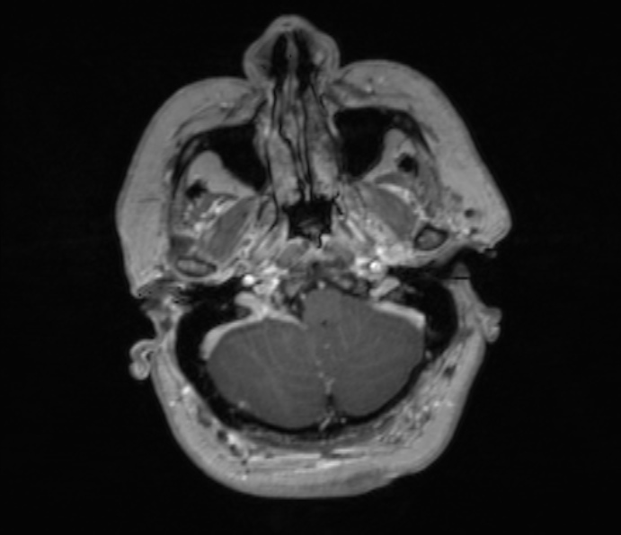 Cerebellopontine angle meningioma (Radiopaedia 35181-36715 Axial T1 C+ 46).jpg