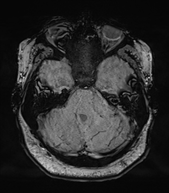 Cerebellopontine angle meningioma (Radiopaedia 48434-53348 Axial SWI 27).png