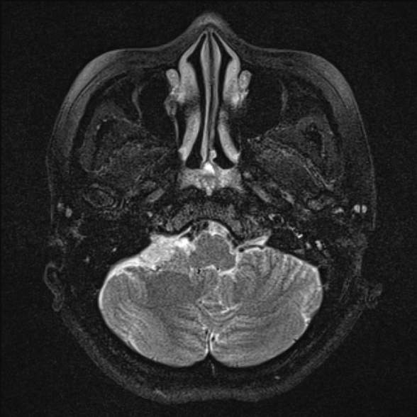 File:Cerebellopontine angle meningioma (Radiopaedia 53561-59591 Axial T2 fat sat 7).jpg