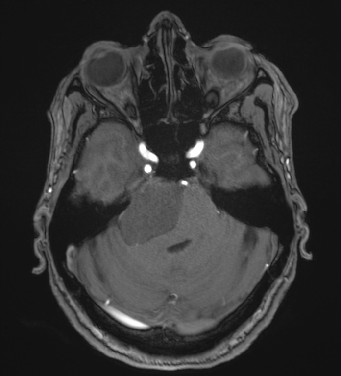 Cerebellopontine angle meningioma (Radiopaedia 72983-83680 Axial MRA 33).jpg