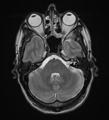 File:Cerebral abscess (Radiopaedia 60342-68009 Axial T2 8).png