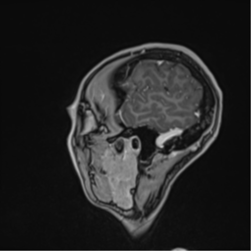 Cerebral abscess (Radiopaedia 60342-68009 J 11).png