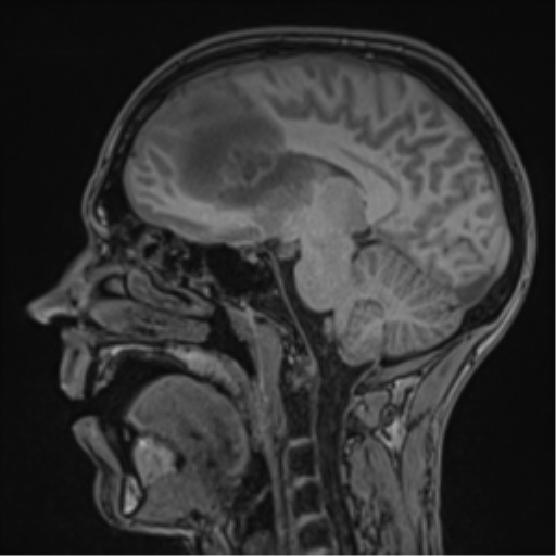 Cerebral abscess (Radiopaedia 60342-68009 Sagittal T1 32).png