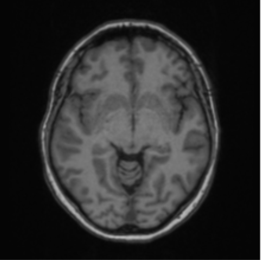 File:Cerebral abscess from pulmonary arteriovenous malformation (Radiopaedia 86275-102291 Axial T1 35).png